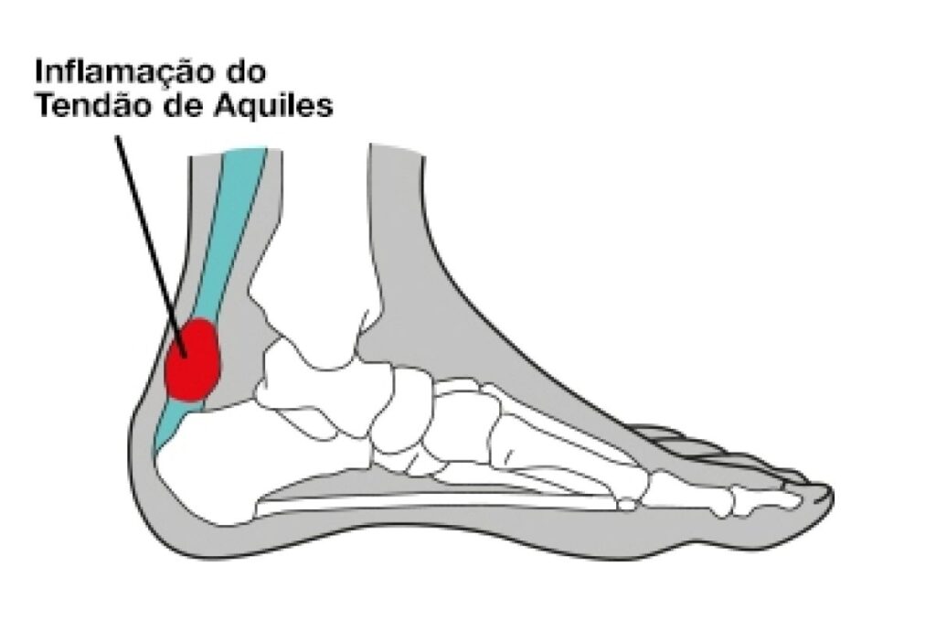 lesão do tendão de aquiles: descubra como tratar