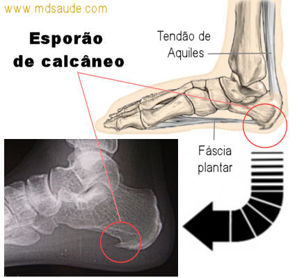 esporão no pé o que é: causas e tratamento