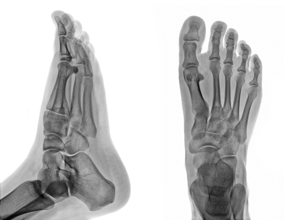 Anatomia dos dedos do pé destacando as falanges e articulações metatarsofalangeanas