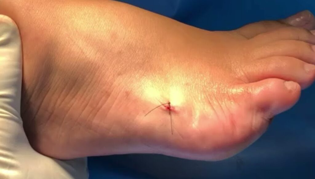 cirurgia joanete minimamente invasiva