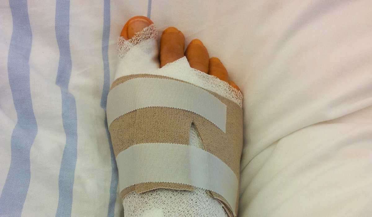 Tempo recuperação cirurgia hallux rigidus - Daniel Baumfeld
